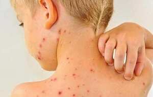 Зроби щеплення від кору безкоштовно! детская больница запорожье КНП «Міська дитяча лікарня №5» ЗМР – це єдина у місті Запоріжжі багатопрофільна дитяча лікарня, де сконцентровано всі види надання спеціалізованої медичної допомоги дитячому населенню: стаціонарної, консультативної амбулаторно-поліклінічної та виїзної для інтенсивної терапії новонародженим.