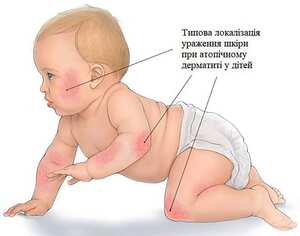 Що таке атопічний дерматит детская больница запорожье КНП «Міська дитяча лікарня №5» ЗМР – це єдина у місті Запоріжжі багатопрофільна дитяча лікарня, де сконцентровано всі види надання спеціалізованої медичної допомоги дитячому населенню: стаціонарної, консультативної амбулаторно-поліклінічної та виїзної для інтенсивної терапії новонародженим.